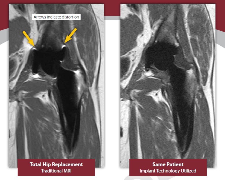 Software for Metal Implant Imaging