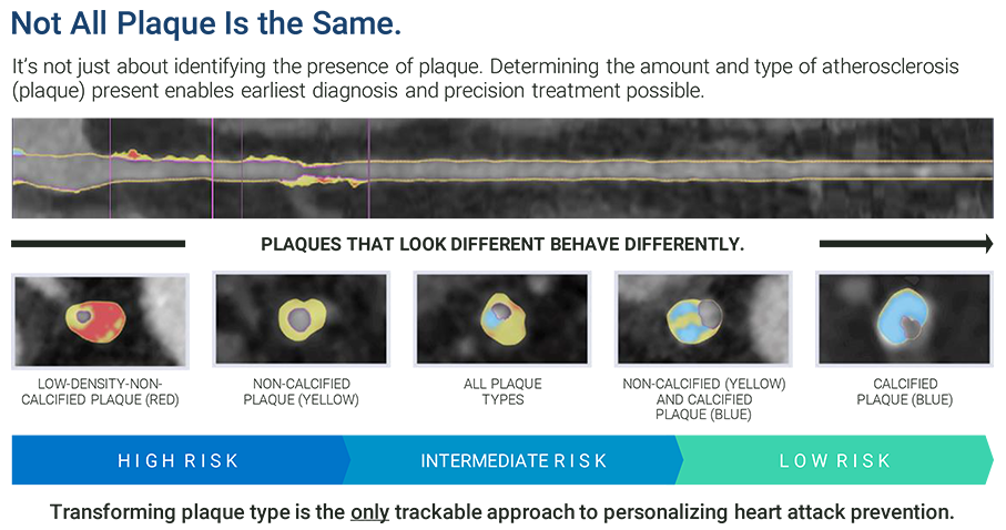 CCTA with AI plaque analyses