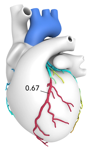 Coronary CTA with Fractional Flow Reserve CT (CCTA w/ FFR CT)