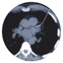 CT Coronary Calcified Plaque Scoring