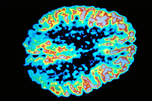 Alzheimer's Disease News