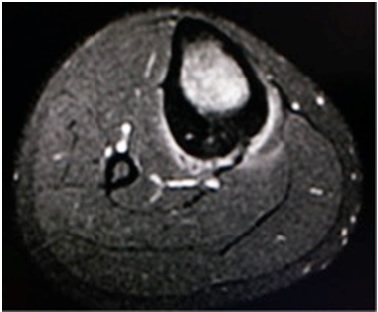 Case Study – Chronic Noninfectious Osteomyelitis (CNO)