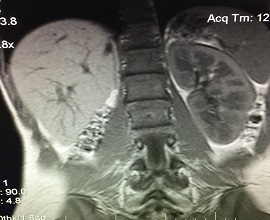 Case Study – OHVIRA Syndrome