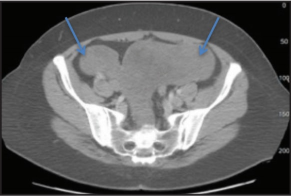 CASE STUDY – DISSEMINATED PERITONEAL LEIOMYOMATOSIS