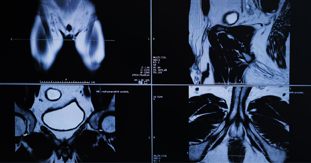 Prostate MRI Prior to Biopsy Reduces Unnecessary Biopsies and Lowers Risk of Missing Significant Cancer